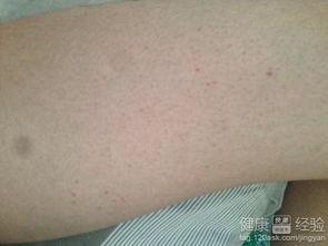 紫癜可以吃方瓜吗,方瓜的适宜与禁忌